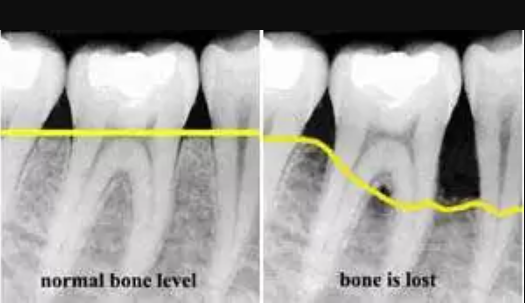 마곡동 치과 정밀 구강 진단을 위한 엑스레이(X-ray) 촬영 필요성과 원리 관련 이미지 4