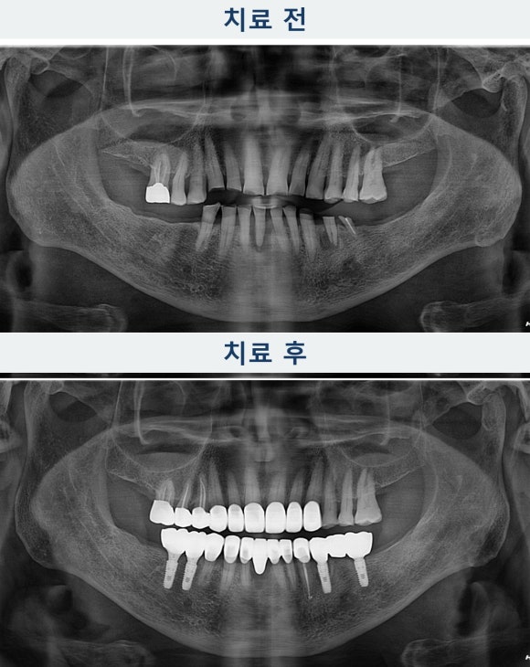 앞니가 많이 닳았다면? 어금니와 씹는 높이를 함께 보는 이유 관련 이미지 2