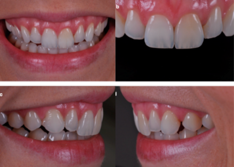 강서구 치과 앞니 라미네이트 제작을 위한 단계 진단 및 분석 절차 과정은? 관련 이미지 2