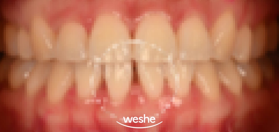[마곡 치과] 교정 후 다시 벌어진 앞니, 재교정 없이 무삭제 라미네이트로 해결 하는 방법 을 알려드리겠습니다. (원내기공실) 관련 이미지 1
