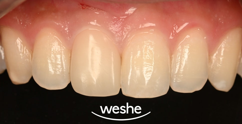 마곡역 치과 앞니 레진 변색 고민 끝, 크라운 치료로 환한 미소 되찾기 관련 이미지 2