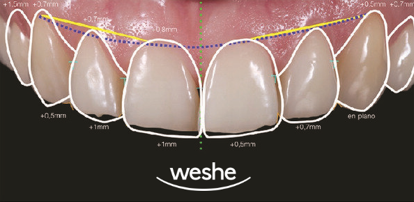 앞니 끝 깨짐 발산 치과 치아 라미네이트 치료 과정 관련 이미지 2