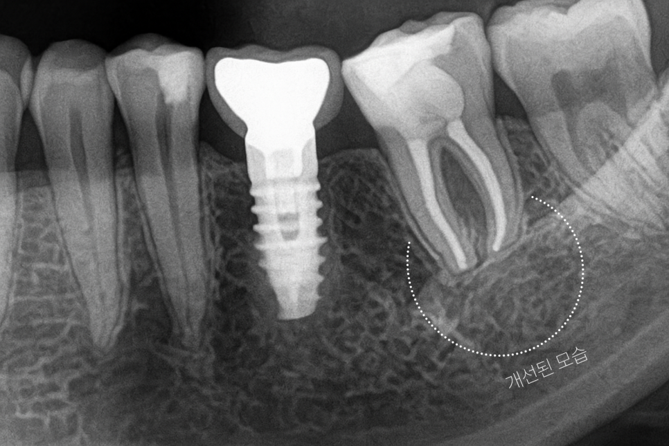 마곡 치과 치아재식술 발치 전 자연치를 살리는 과정 관련 이미지 9