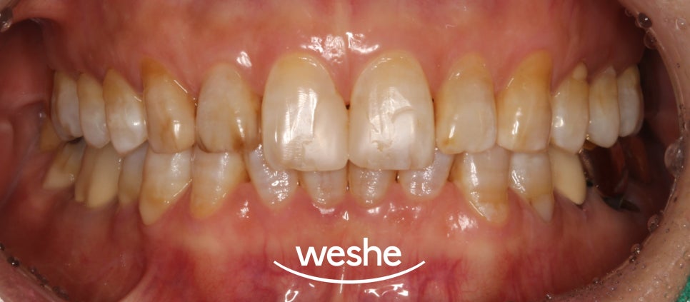 에어플로우와 초음파 스케일링 차이점과 단계별 치료 과정 강서구 치과 관련 이미지 3