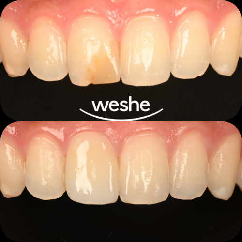 마곡역 치과 앞니 레진 변색 고민 끝, 크라운 치료로 환한 미소 되찾기 관련 이미지 3