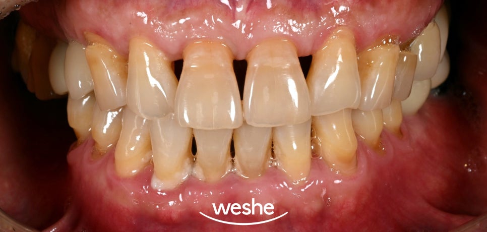 마곡역 치과 구강 관리의 기초는? 칫솔질, 스케일링, 잇몸치료의 중요성 관련 이미지 1