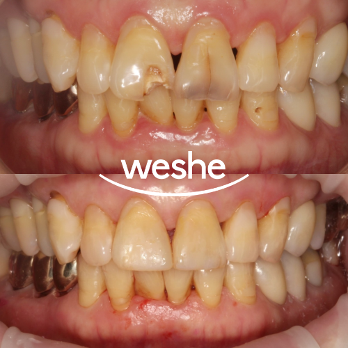 마곡 치과 앞니 파절, 충치 치아 레진으로 하루만에 해결할 수 있을까? 첫인상 하루만에 바꾸기 관련 이미지 8