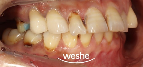 마곡역 치과 기공실과 기공소의 차이와 그에 따른 임플란트 진료 과정 관련 이미지 5