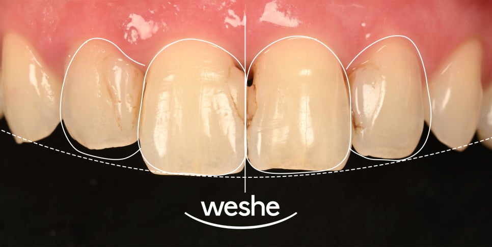 앞니 레진 변색, 티 안 나는 라미네이트 교체와 비율 개선할 수 있을까? 마곡역 치과 관련 이미지 4
