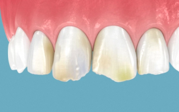 Gangseo-gu Dental Clinic: Wondering Whether to Choose Whitening, Orthodontics, or Veneers? image 2