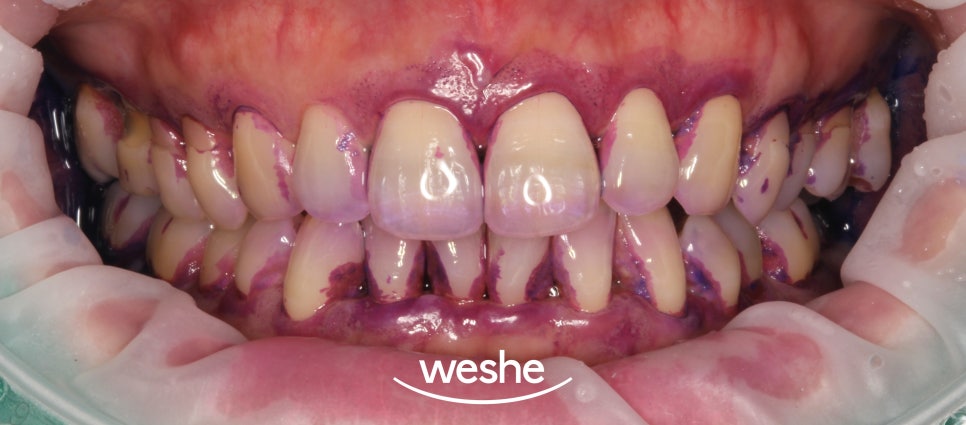 송정역 치과 잇몸 내려앉음이 나타날 때 할 수 있는 아랫니 치석 제거, 집에서도 할 수 있을까요? 관련 이미지 6