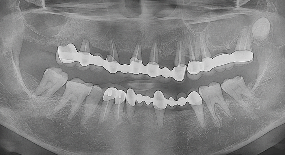 위턱 전체 임플란트 마곡동 치과 수면치료(의식하진정법)을 활용한 진료 방법 관련 이미지 3