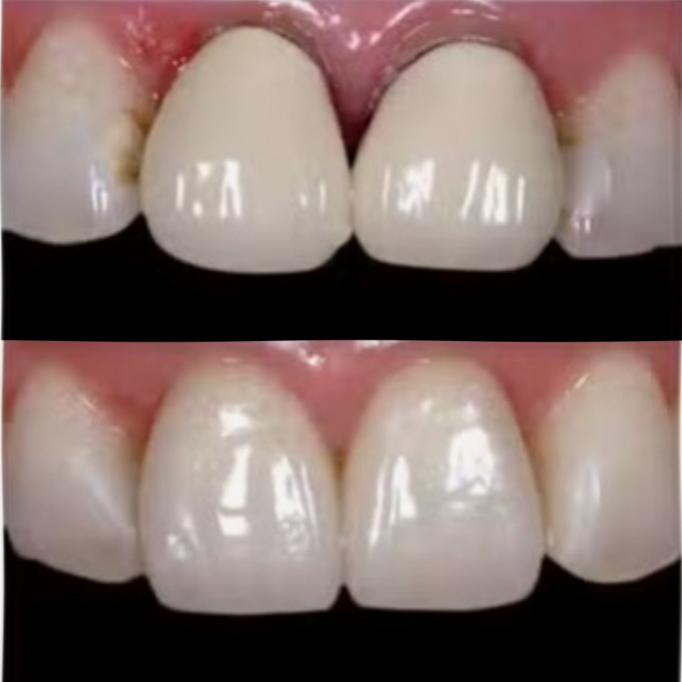 강서구 마곡동 치과 잇몸 경계의 검은 선, 지르코니아 크라운 으로 지울 수 있을까? 관련 이미지 6