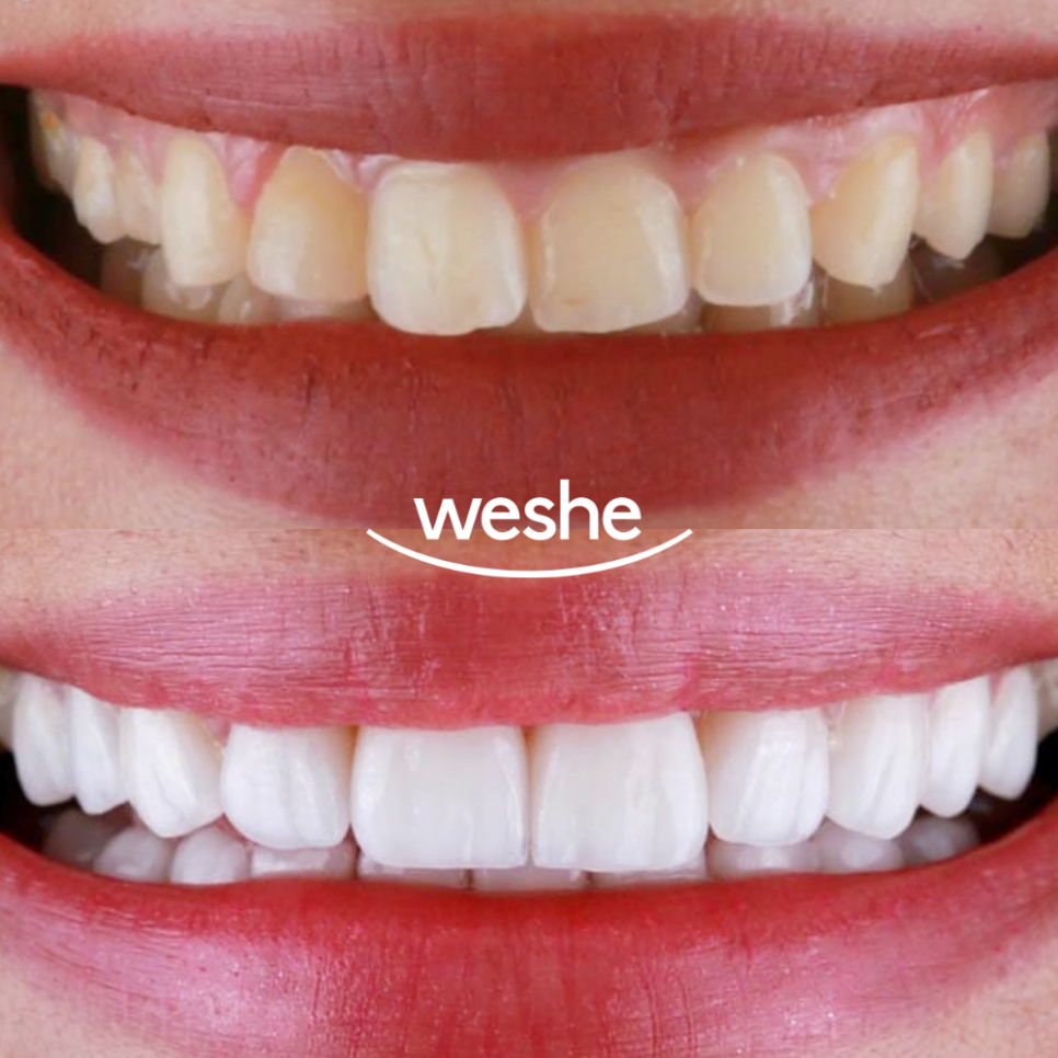 마곡역 치과 삐뚤빼뚤하고 치아 끝 살짝 깨진 앞니, 교정 대신 라미네이트 수복으로 치료 과정 관련 이미지 4