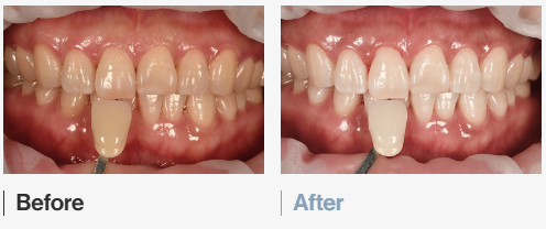 Magok Teeth Whitening: WISH Whitening Combining Professional and At-Home Whitening image 11