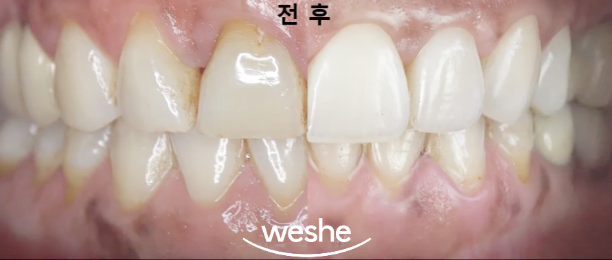 강서구 치과 웃을 때 앞니가 이상해 보인다면? 라미네이트 치료 로 자신감을 되찾으세요 관련 이미지 6