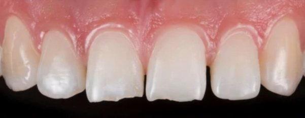 앞니 끝 깨짐 연세위시치과 라미네이트 제작 과정, 관리 관련 이미지 1