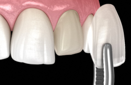 Gangseo-gu Dental Clinic: Wondering Whether to Choose Whitening, Orthodontics, or Veneers? image 6