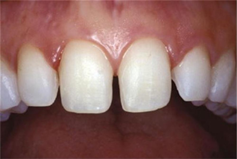 송정 치과 앞니 레진 변색 제거 후 전치부 치아 라미네이트 과정 관련 이미지 3