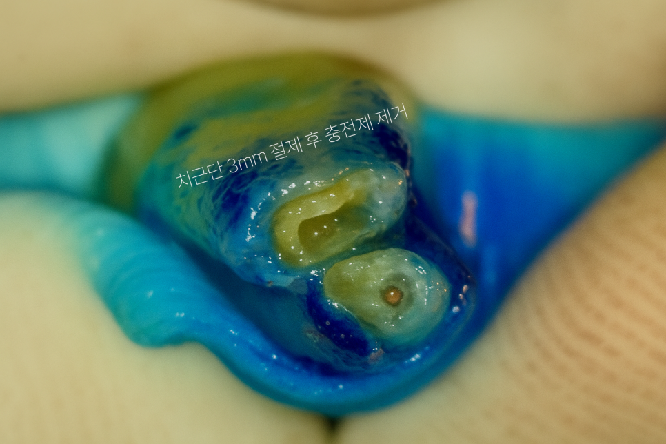 마곡 치과 치아재식술 발치 전 자연치를 살리는 과정 관련 이미지 7