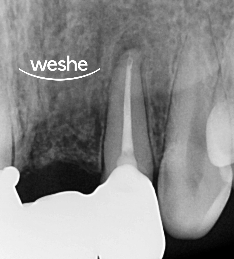 마곡역 치과 잇몸 아래 부러진 치아, 발치 없이 살릴 수 있는 방법은? 교정적 정출술을 동반한 신경치료 관련 이미지 7