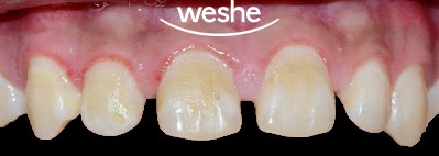 [강서구 치과] 치간이개, 앞니가 벌어졌다?! 치아 벌어짐, 초기 충치/ 라미네이트 치료 과정 관련 이미지 1