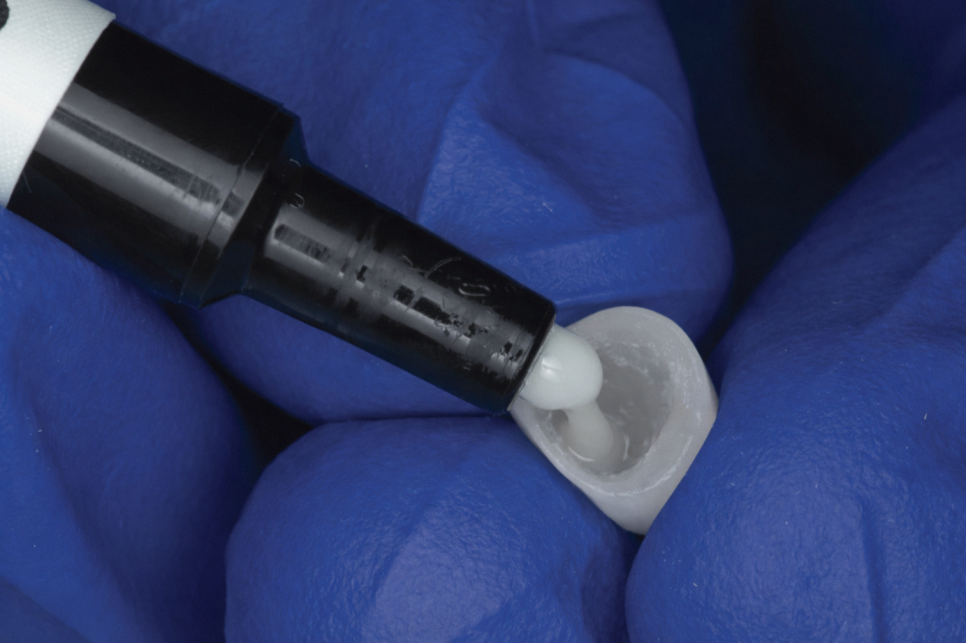 Maggok Station Dental Clinic: There Is a Reason the Lifespan of My Aesthetic Prosthetics Is Short — Information You Need to Know to Make Them Last Longer image 2