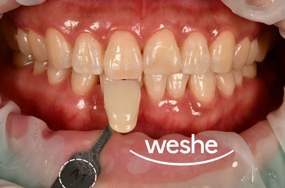 발산 치과 치아 미백 과정과 주의해야 되는 사항은? 담배, 커피 관련 이미지 7