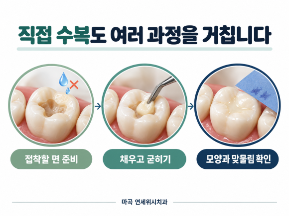 마곡 치아색 충치치료, 레진과 인레이가 다르게 들리는 이유 관련 이미지 2