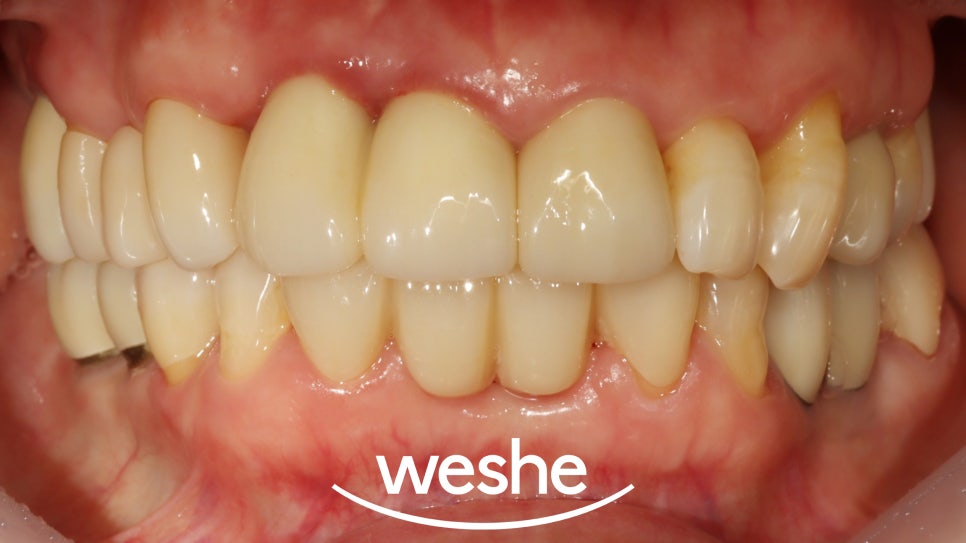 벌어진 치아 사이 (치간이개) 와 치주질환 이 동시에 있을 때, 송정역 치과 임플란트 치료 설명글 관련 이미지 9