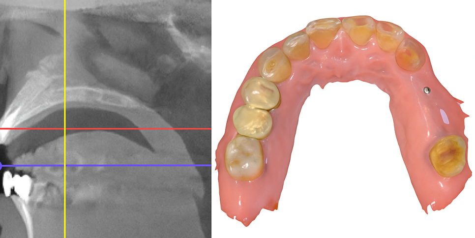 강서구 치과 어금니 임플란트 가용골 부족할 때 네비게이션 1차 2차 수술 로 해결하는 방법 관련 이미지 3