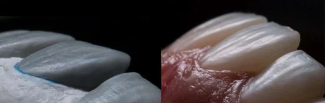 앞니 끝 깨짐 연세위시치과 라미네이트 제작 과정, 관리 관련 이미지 2