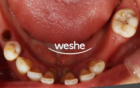 벌어진 치아 사이 (치간이개) 와 치주질환 이 동시에 있을 때, 송정역 치과 임플란트 치료 설명글 관련 이미지 8