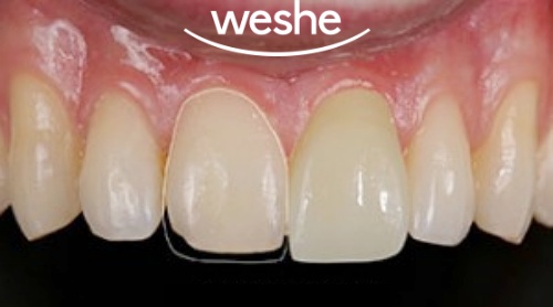 마곡 치과 앞니 깨짐! 레진으로는 부족할 때? 라미네이트(Veneer) 치료 과정 관련 이미지 4