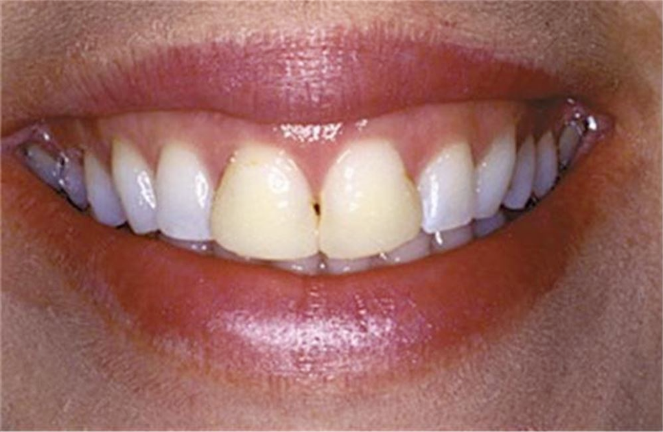 송정 치과 앞니 레진 변색 제거 후 전치부 치아 라미네이트 과정 관련 이미지 1