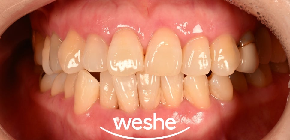 마곡동 치과 EMS 스케일링 관련 이미지 1