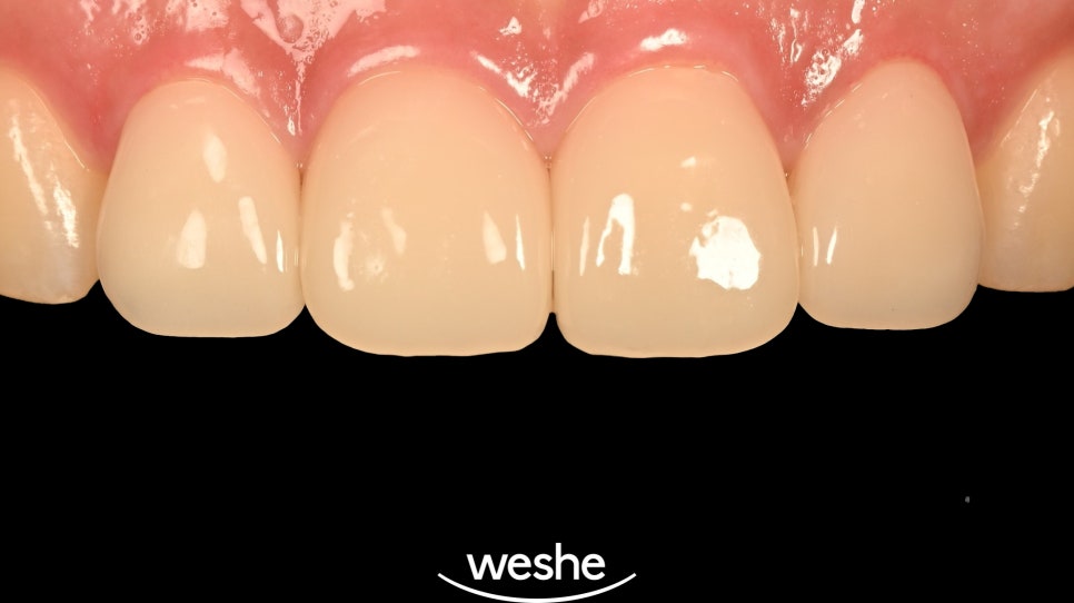 앞니 치아 파절, 마곡 치과 치료 기준과 지르코니아 크라운의 심미적 비율 관련 이미지 5