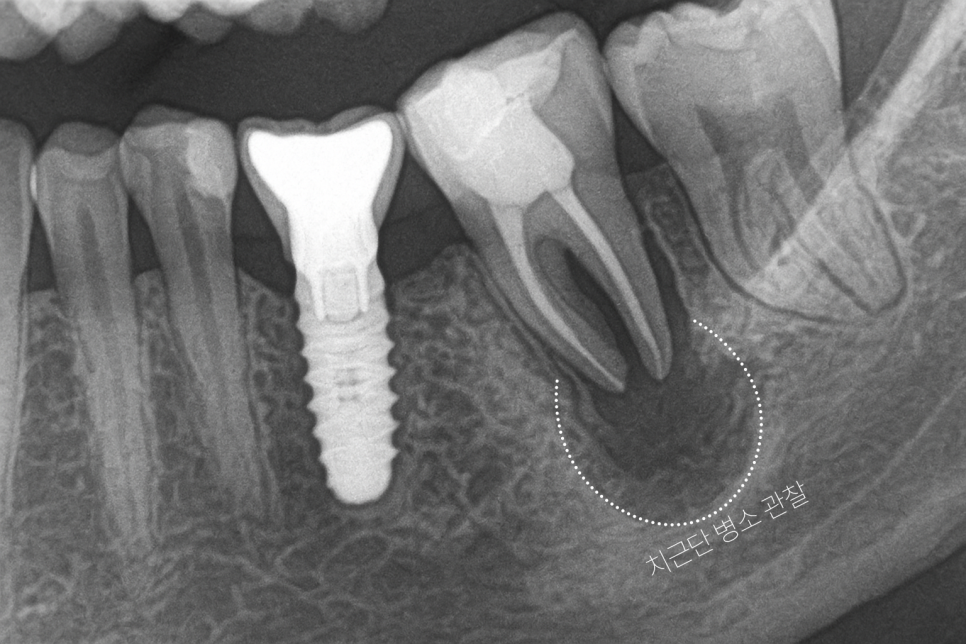 마곡 치과 치아재식술 발치 전 자연치를 살리는 과정 관련 이미지 6