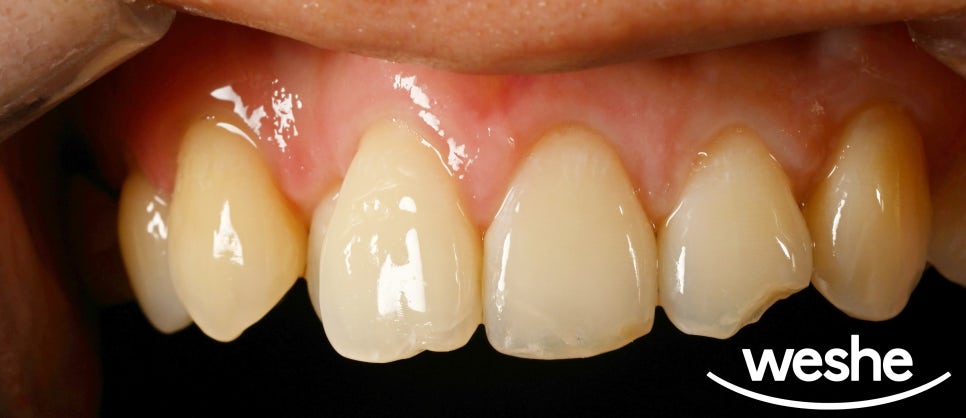 마곡 치과 넘어짐 으로 인한 앞니 치아 끝 살짝 깨짐, 증상에 따라 치료 방법이 달라집니다. 레진 수복 케이스 관련 이미지 2