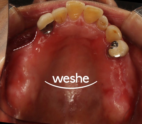 강서구 치과 어금니 임플란트 가용골 부족할 때 네비게이션 1차 2차 수술 로 해결하는 방법 관련 이미지 4