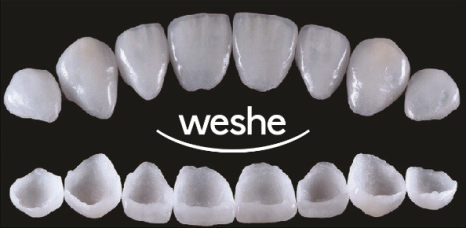 앞니 끝 깨짐 발산 치과 치아 라미네이트 치료 과정 관련 이미지 8