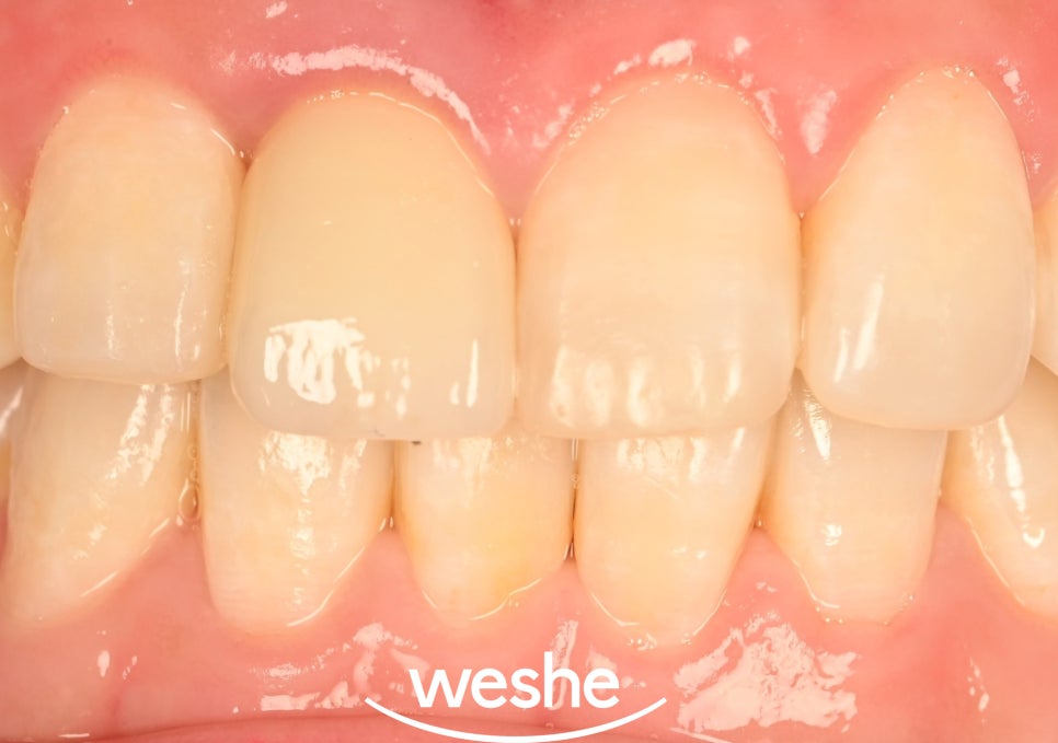 발산 치과 치수 치료 받은 앞니 변색, 왜 크라운이 필요할까? 관련 이미지 3