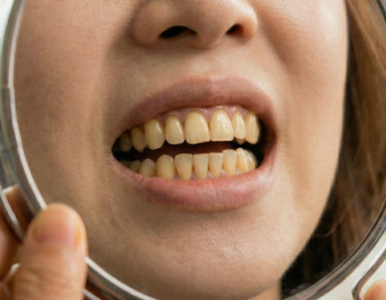 Magok Teeth Whitening: WISH Whitening Combining Professional and At-Home Whitening image 3