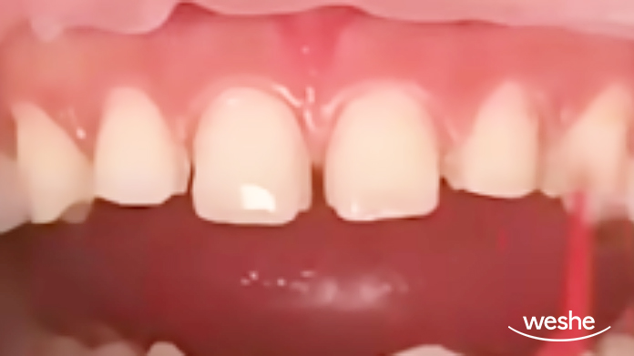 송정역 치과 앞니가 벌어졌을 때, 심미치료를 위한 라미네이트 제작 시 고려사항 관련 이미지 2