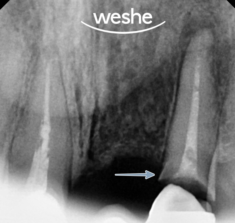 마곡역 치과 잇몸 아래 부러진 치아, 발치 없이 살릴 수 있는 방법은? 교정적 정출술을 동반한 신경치료 관련 이미지 4