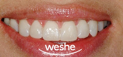 송정역 치과 치간이개(앞니 사이 벌어짐)의 원인과 해결법, 라미네이트 수복 과정 정리 관련 이미지 3