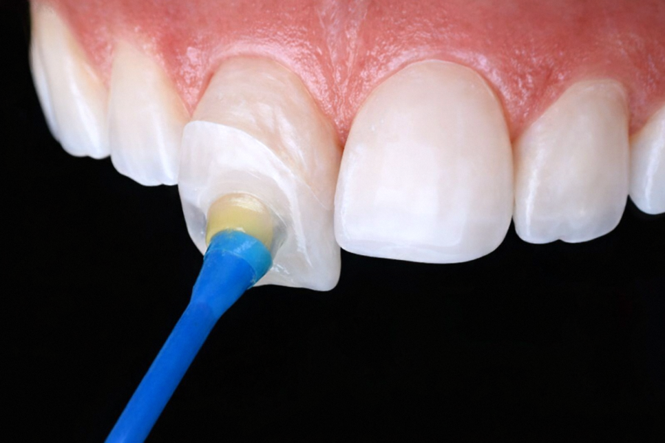 마곡 치과 앞니 깨짐, 레진과 라미네이트 중 무엇이 맞을까? 손상 범위에 따른 치료 방법 관련 이미지 4