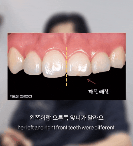 결혼 전 치아가 신경 쓰인다면, 어디까지 바꾸는 게 좋을까요? 관련 이미지 4
