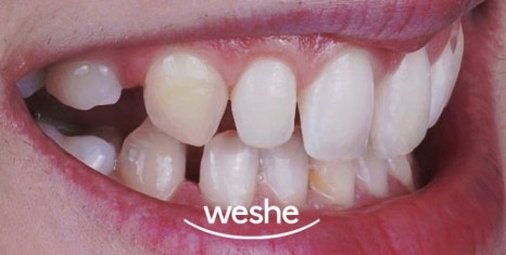 😁 웃을 때 치아 사이 가 벌어져 보인다면? 마곡동 치과 라미네이트 로 해결! 관련 이미지 3