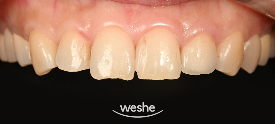 마곡동 치과 라미네이트 앞니 미세 파절, 변색 치료 사례 분석정리 관련 이미지 2